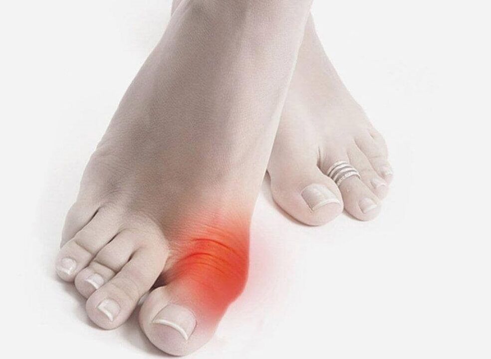 síntomas do pé de gota